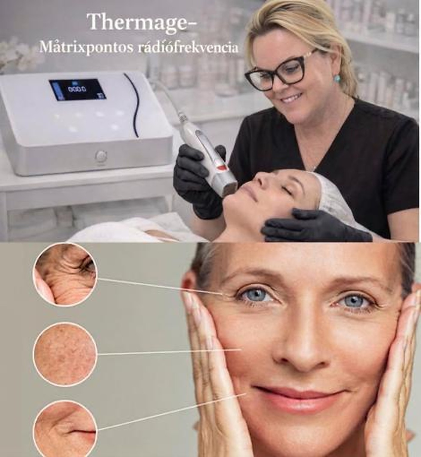 Thermage / ThermaLift kezelés
